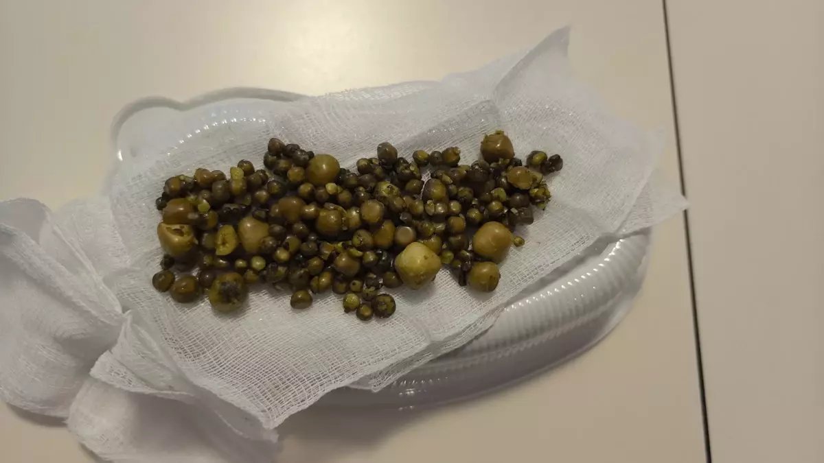 İnegöl'de 213 Safra Taşı Bulunan Kadın Başarıyla Ameliyat Edildi