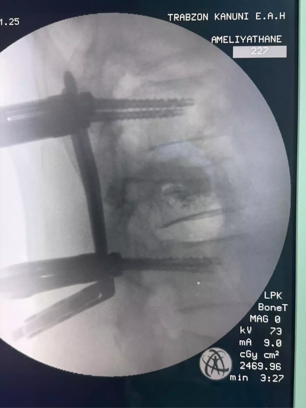 Kanuni Eğitim ve Araştırma Hastanesi'nde Başarıyla Omurga Ameliyatı Gerçekleştirildi