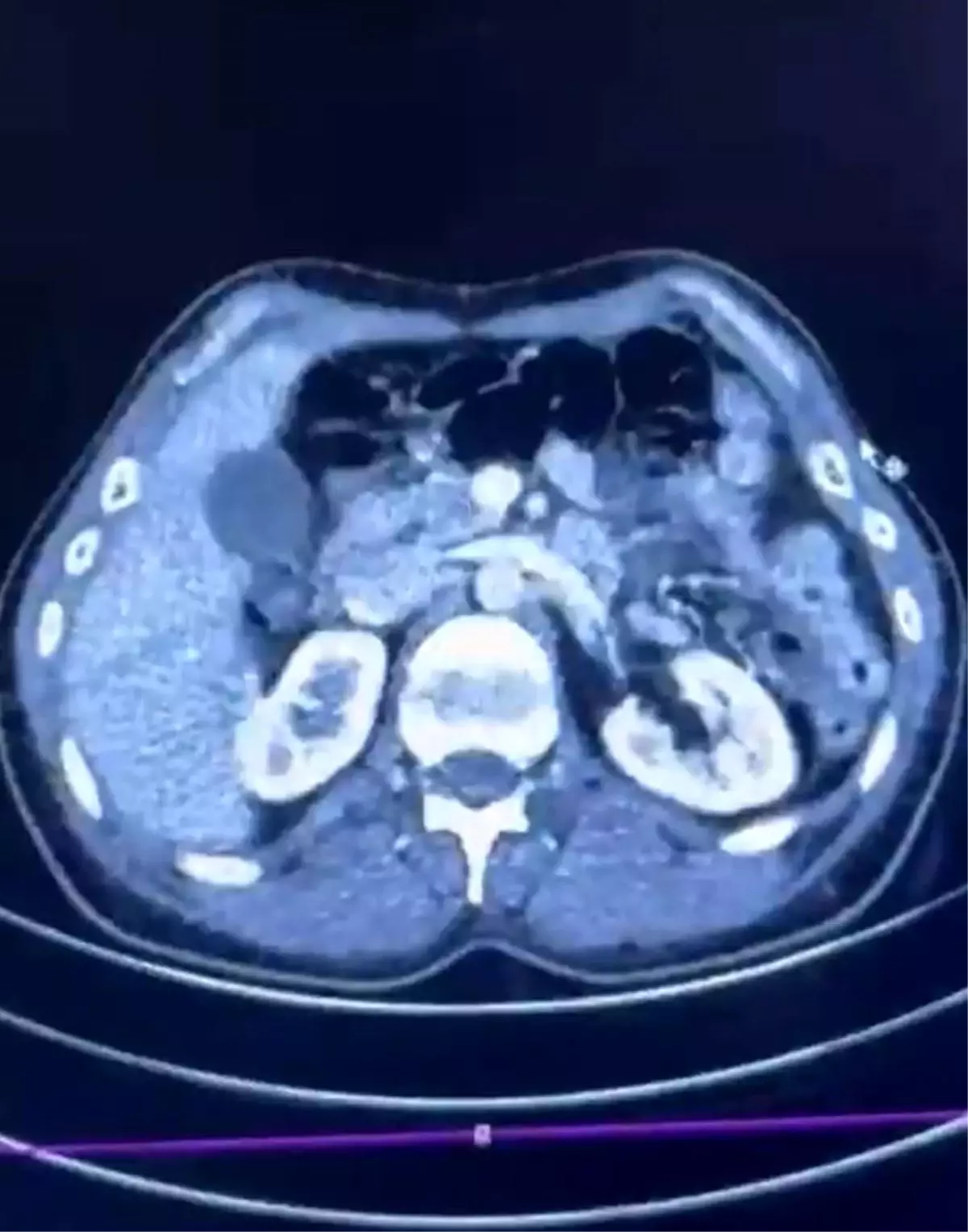 Ülkeye midelerinde uyuşturucu getiren şahıslar yakalandı