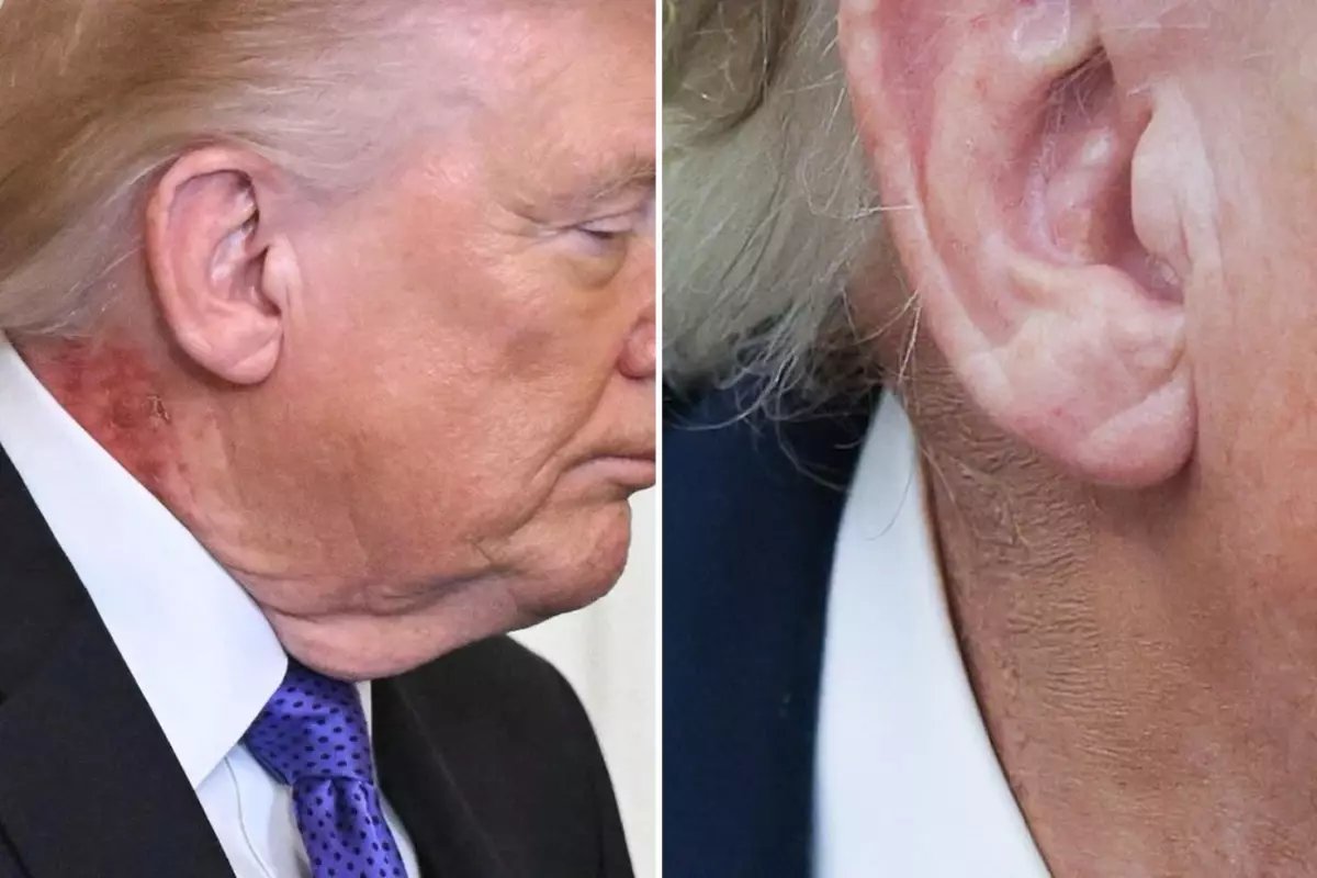 Trump'ın boynundaki kızarıklığı gizleme çabası